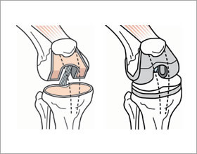 図1-2　人工膝関節全置換術