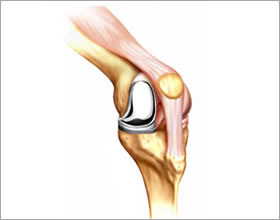 図2　人工膝関節単顆置換術