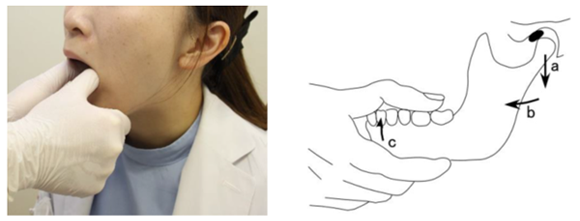 徒手的顎関節授動術（マニピュレーション）の方法