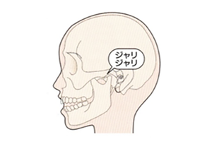 変形性顎関節症（Ⅳ型）