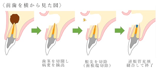 一般的な歯根端切除術 