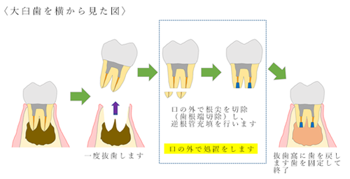 抜歯および意図的再植手術