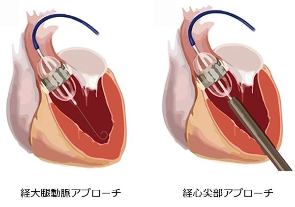 心臓弁漏れのためのライフスタイルの変化