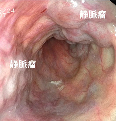 食道静脈瘤（内視鏡写真）
