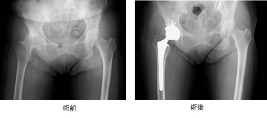 人工股関節全置換術 手術前と後の比較