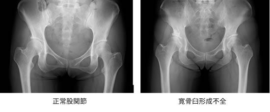 正常な股関節と臼蓋形成不全の股関節