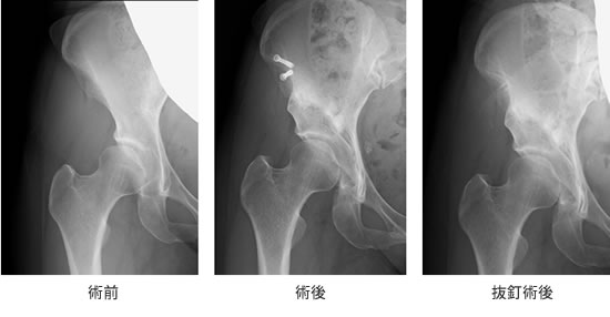 正常な股関節と臼蓋形成不全の股関節